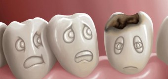 Nhổ răng khôn mọc ngầm – wisdom tooth removal partial bony